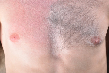 Fototapeta premium Male depilation. Half of male chest without hair after waxing. Close-up