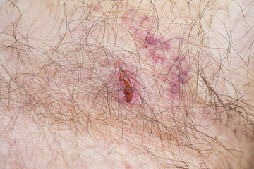 Caucasian male hairy leg wounded skin with bruise and scaring close up macro shot