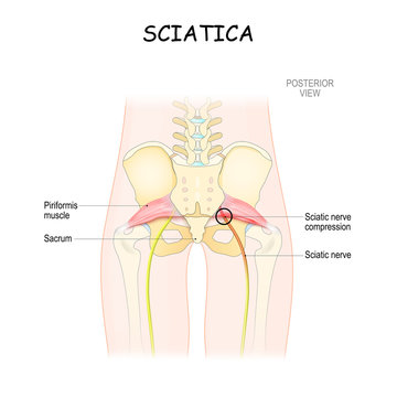 sciatica. piriformis syndrome