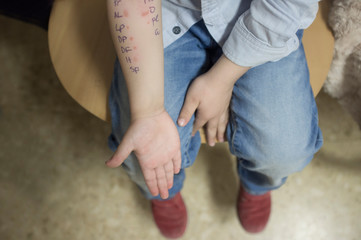 Little boy arm full of weals just after doing allergy skin prick test