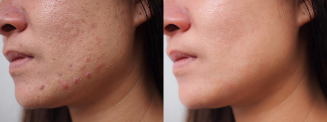 Image before and after spot red scar acne.pimples treatment on face asian woman.Problem skincare...