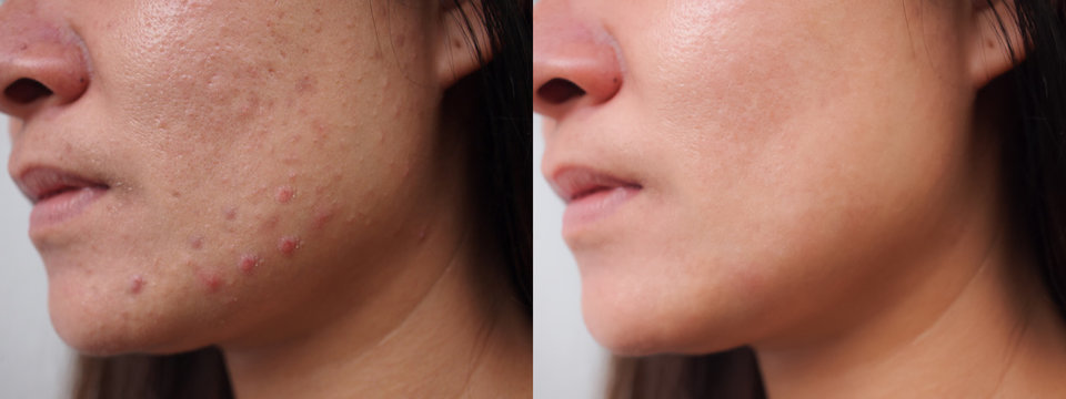 Image before and after spot red scar acne.pimples treatment on face asian woman.Problem skincare and beauty concept.