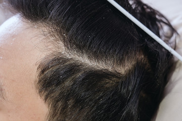 Close up of a hair dandruff , Black hair
 - obrazy, fototapety, plakaty