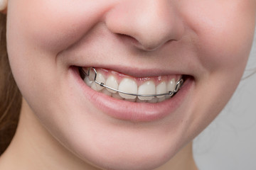 close up of mouth of young female teenager with a dental brace