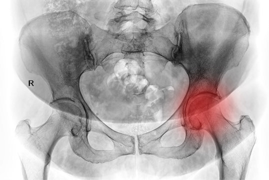Radiography x-ray film of human pelvis