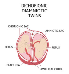 Anatomy of abdomen with twins. Twin types infographic elements in flat design. Monozygotic or Dizygotic Placentation of twins medical