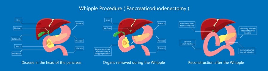 Whipple procedure pancreaticoduodenectomy Pancreatic cancer treatment total pancreatectomy Small bowel surgical  - obrazy, fototapety, plakaty