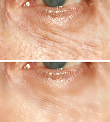 Fototapeta premium Wrinkles under the eyes. Wrinkles on the skin of the face. Flabby eyelids. Before and after treatment with a cosmetic procedure