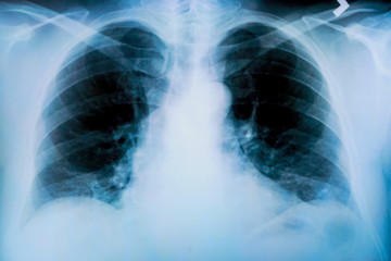 X-ray of a patient's lungs with pronounced traces of the inflammatory process .