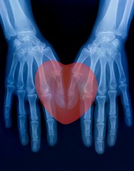 X-ray plate of the bones of the both human hands and red heart sign