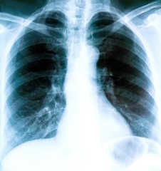 X-ray of a patient's lungs with pronounced traces of the inflammatory process