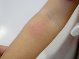 Close up of redness, itching, swelling, and wound from scratches after a mosquito bite on a little baby's arm