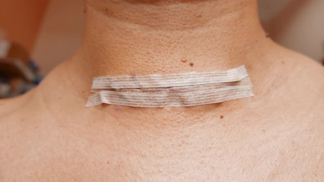 Static close up of thyroid operation scar of a man with adhesive bandage is still intact.