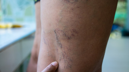 Fototapeta premium Varicose veins on young women legs