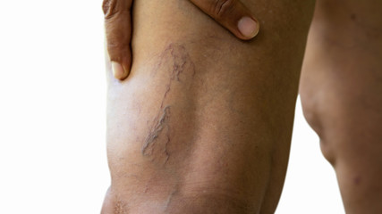 Naklejka premium Varicose veins on young women legs