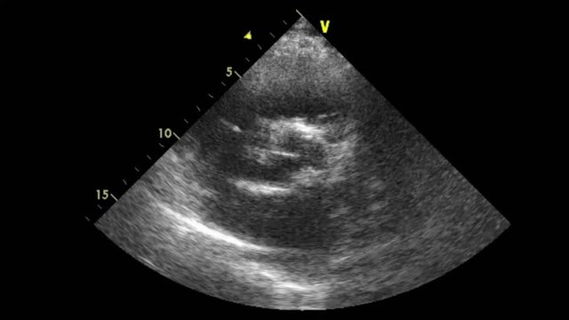 Transesophageal ultrasound video in gray-scale mode.