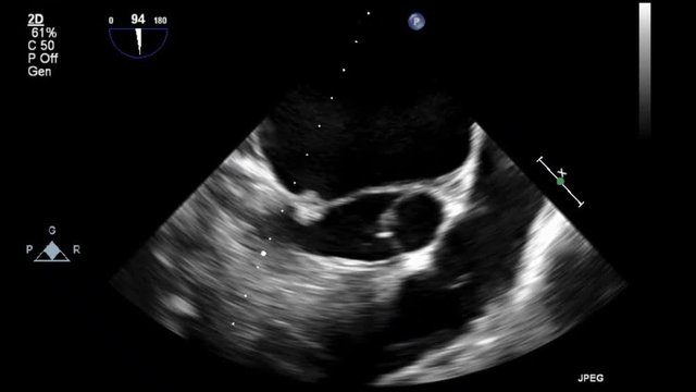 Transesophageal ultrasound video in gray-scale mode.