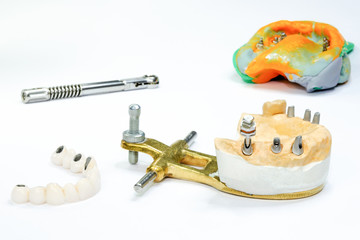 jaw model with dental implants and ceramic crowns. in the background is a dental impression with...
