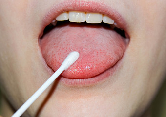 Tongue protruding from the mouth with a cotton swab held up for analysis. Disinfection and treatment of the oral cavity for viruses and infections. Coronavirus