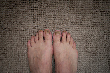 Onychomycosis with fungal nail infection two feet.