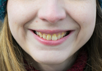 Yellow teeth of a girl, fluorosis. Smoker's problem teeth caused by fluoride, smoking, or coffee....
