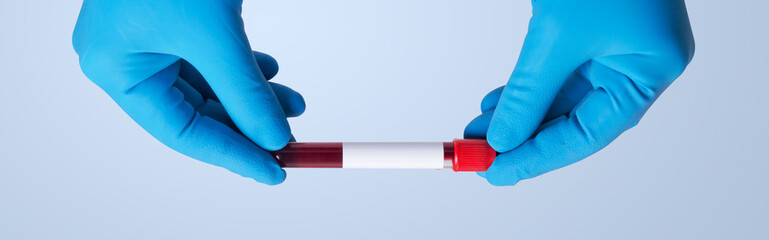 Coronavirus 2019-nCoV Blood Sample.