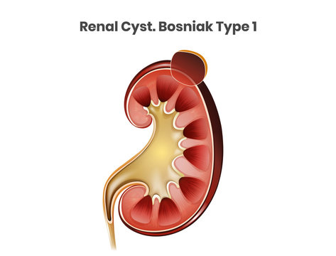 Renal cyst, Bosniak type 1. A simple cyst of the kidney