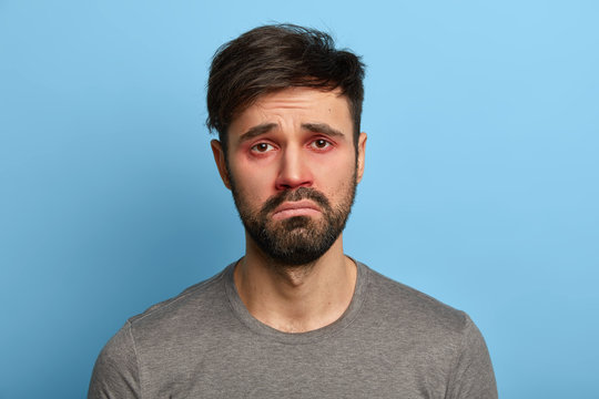 Miserable displeased man has sick look, red swollen eyes, smirks face, suffers from conjunctivitis, seasonal allergy, poses against blue background. People, disease, health problems concept.