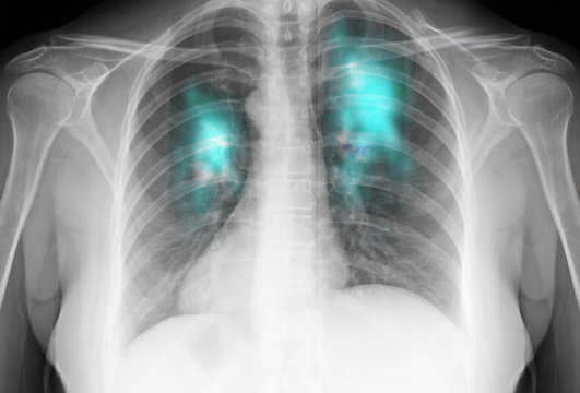 Coronavirus - 2019-nCoV Wuhan Virus Concept- Complete with X-ray Film Lungs