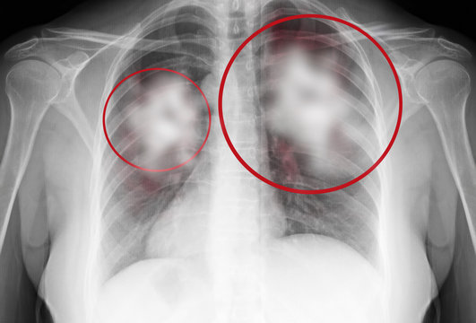 Coronavirus - 2019-nCoV Wuhan Virus Concept- Complete with X-ray Film Lungs