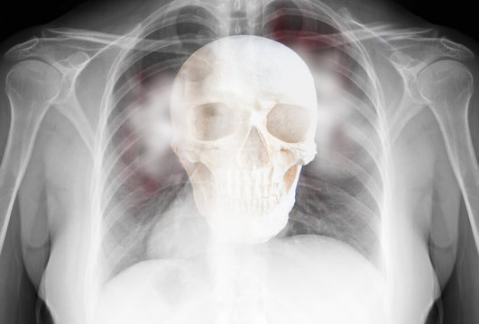 Coronavirus - 2019-nCoV Wuhan Virus Concept- Complete with X-ray Film Lungs