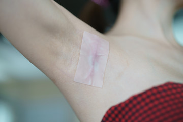 Paste a medical silicone sheet To treat the keloids scar on the armpit after breast surgery.