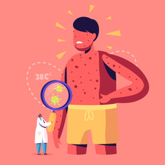 Chicken Pox Varicella Symptoms Concept. Tiny Doctor Character with Magnifying Glass Looking on Germs at Huge Boy with Red Pimples on Body. People Vaccination, Immunization. Cartoon Vector Illustration - obrazy, fototapety, plakaty