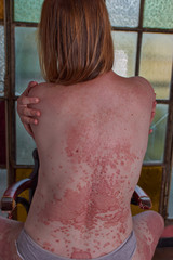 Woman's back with psoriasis