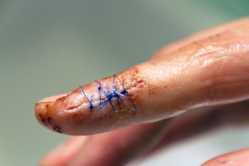Wounded Finger With Bloody Stitches Close Up