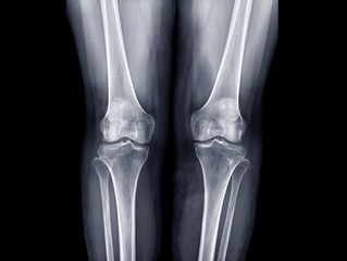 x-ray image of  both knee AP view for detect Osteoarthritis Knee or OA Knee .
