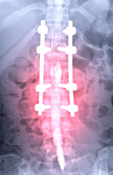  myelography is particularly sensitive at detecting small disk herniations compressing nerves of the spine .
