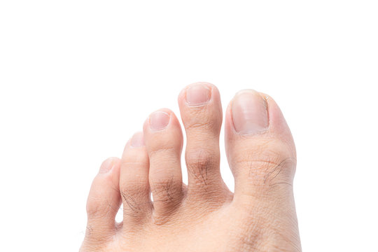Close up of male foot and dirty long toe nail isolated on white background with clipping path. medical foot and cleanliness concept.