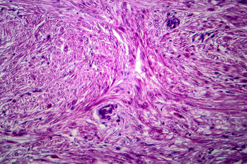 Uterine leiomyoma, light micrograph
