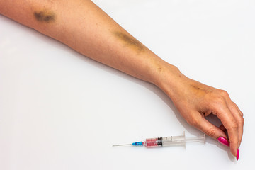 Female hand with bruises from injecting drugs with a syringe.