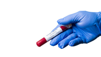 Chinese SARS-CoV-2 Corona Virus Blood Test Concept.