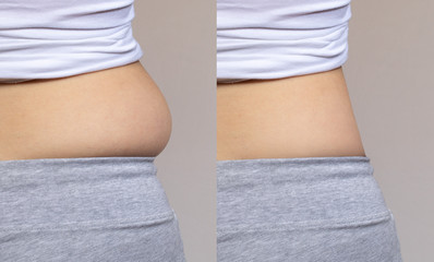 Collage comparison before and after successful weight loss. Female body closeup...