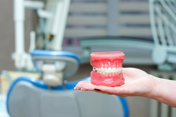 Orthodontic model and dentist tool - demonstration teeth model of varities of orthodontic bracket or brace. Metal and ceramic braces on teeth on an artificial jaws in female hand closeup