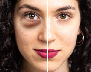 Deep dark puffy under eye bags side by side comparison