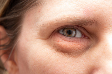 Obraz premium Closeup of wrinkles and heavy puffiness in the eye region of a middle aged woman. Plastic surgery concept