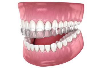 Invisalign braces or invisible retainer. Medically accurate dental 3D illustration