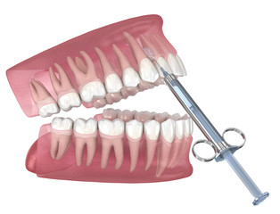 Fototapeta na wymiar Local Dental anesthesia. 3D illustration of dental treatment