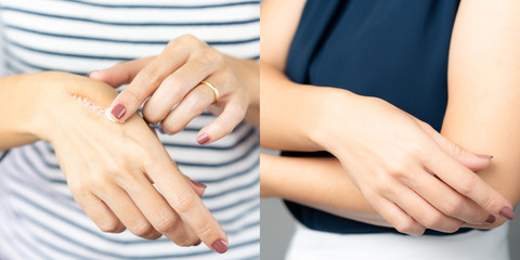 A woman applying scar removal cream to healed the cooking oil burn scar on a her hands. Healing,...
