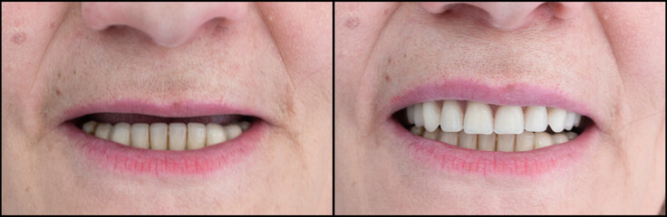 reconstracting full upper jaw by implants and denture © Garo