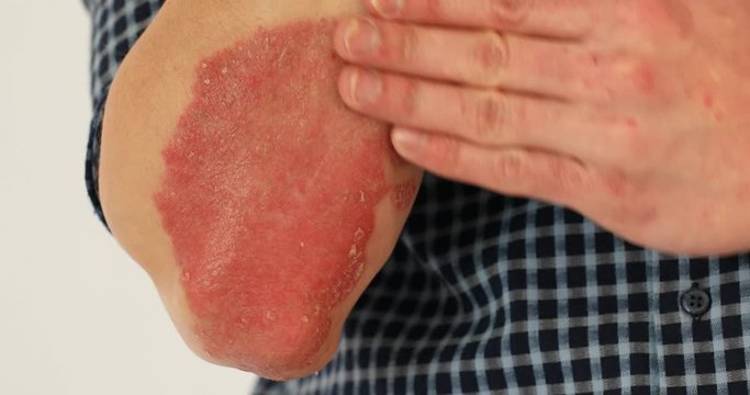 Man with sick hands, dry flaky skin on his hand with vulgar psoriasis, eczema and other skin diseases such as fungus, plaque, rash and blemishes. Autoimmune genetic disease.
